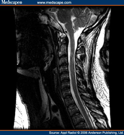 Multiple Sclerosis (MS) of the Spinal Cord