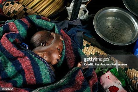 Malnutrition Africa Photos and Premium High Res Pictures - Getty Images