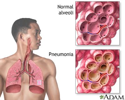 PNEUMONIA (Asuhan Keperawatan Klien dengan Pneumonia) ~ Passion to Action