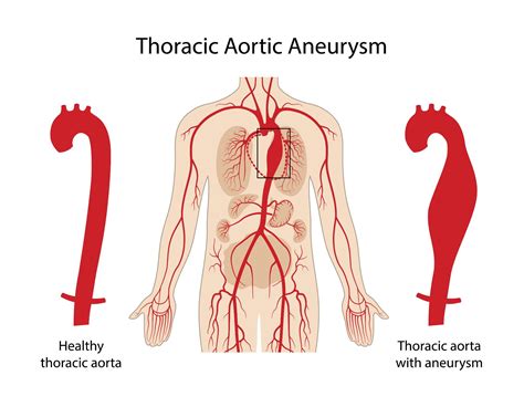 Ascending And Descending Aorta