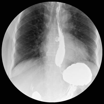 Esophageal diverticulum | Radiology Reference Article | Radiopaedia.org