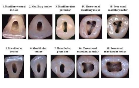 Access Cavity Preparation. | Anatomie dentaire, Dentaire, Art dentaire