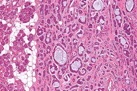 Adenoid Cystic Carcinoma: มะเร็งหายากในต่อมน้ำลาย - โรคมะเร็ง 2024