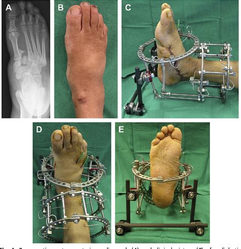 Circular External Fixation as a Primary or Adjunctive Therapy for the Podoplastic Approach of ...