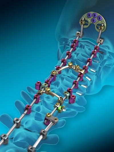 Medtronic spinal product gets FDA clearance - Memphis Business Journal