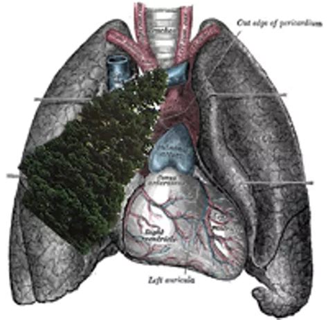 Signs of Spring: Fir Tree Found Growing in Man's Lungs