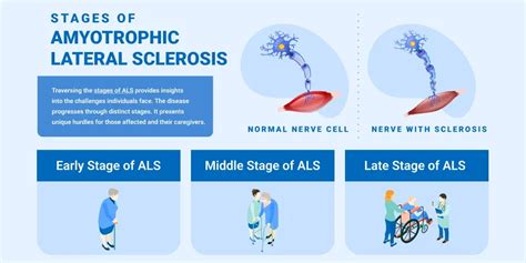 ALS: stages and patterns of disease development