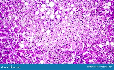 Histopathology Of Liver Abscess Stock Image | CartoonDealer.com #120408079