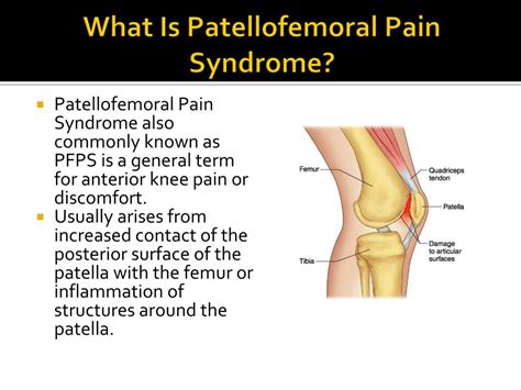 Patellofemoral Pain Syndrome Pfps Physioflow