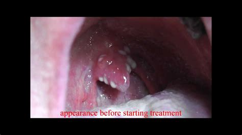 oral candidiasis (thrush) before and 18 hours after treatment - YouTube