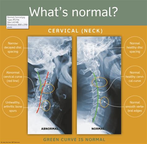 1. Normal_Cervical | Chiropractic, Cervical, Health chart