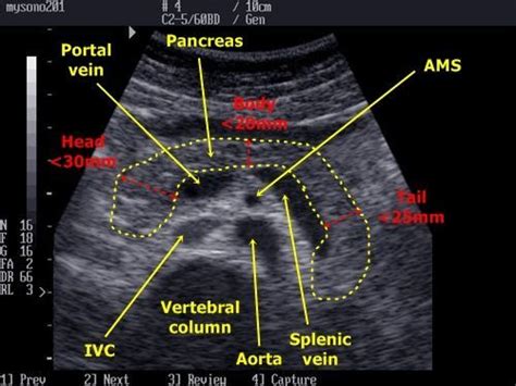 Long Pancreas w/vascularity labeled | Sonography, Medical ultrasound ...