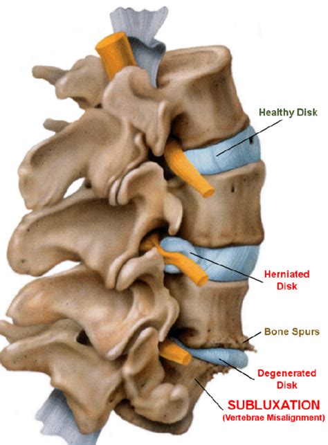 What is a Subluxation - Upper Cervical Chiropractic San Diego