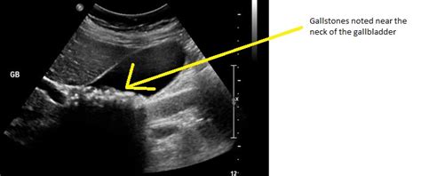 Gallbladder Ultrasound