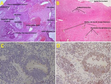 Teratoma Histology