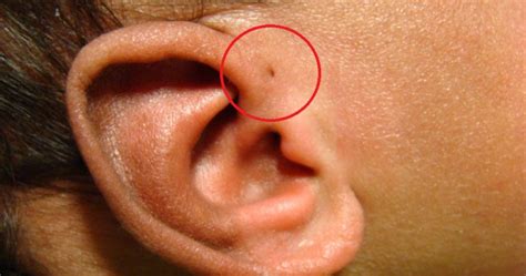 Have you seen someone with a ‘Tiny Hole’ above their ears? This is what ...