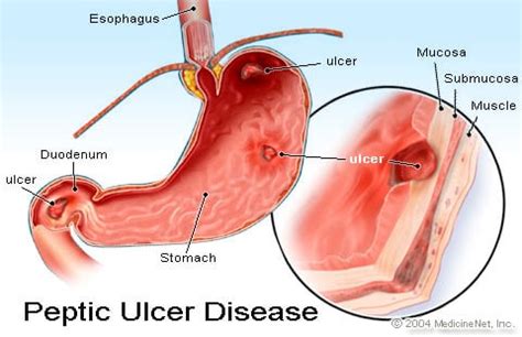 Gastritis, Gastrointestinal Bleeding and Peptic Ulcer