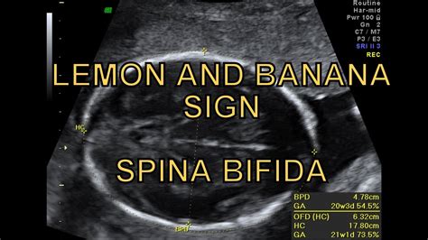 Spina Bifida Ultrasound