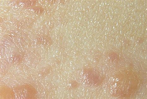 Dermatitis Herpetiformis - Photos, Symptoms, Causes, Treatment