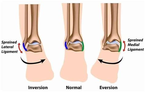 Types of Ankle Sprains, Symptoms and Treatments: Phoenician Foot ...