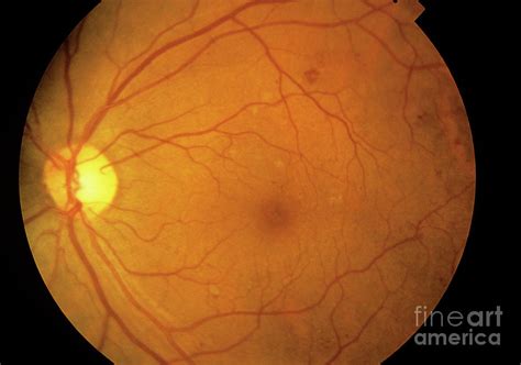 Fundus Camera Image: Diabetic Retinopathy Photograph by Western ...