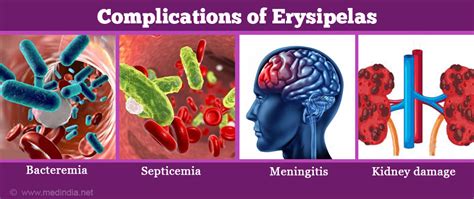 Erysipelas - Causes, Symptoms, Diagnosis, Complications, Treatment & Prevention