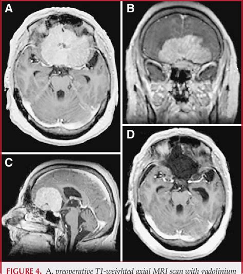 Olfactory Groove Meningioma | Semantic Scholar