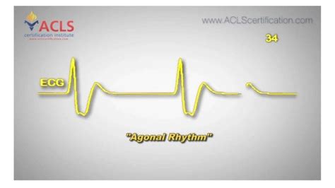 Agonal Rhythm by ACLS Certification Institute