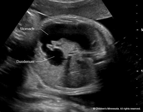 Duodenal Atresia Fetal Ultrasound