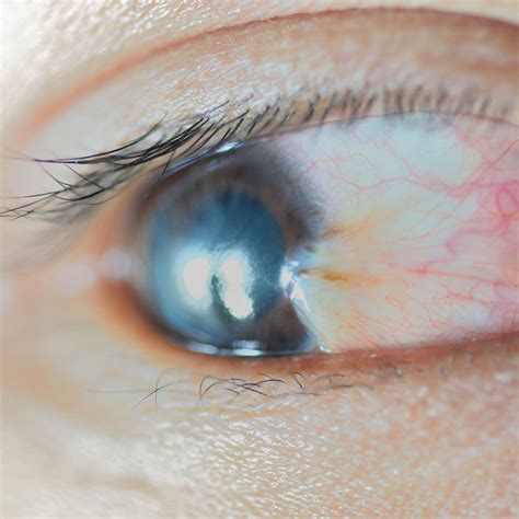 Bump on Eyeball: Causes, Symptoms, and Treatment