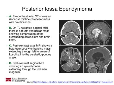 Ependymoma