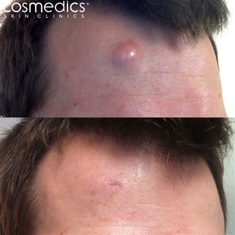 Cyst Removal London Surgical Treatment | Cosmedics Skin Clinics