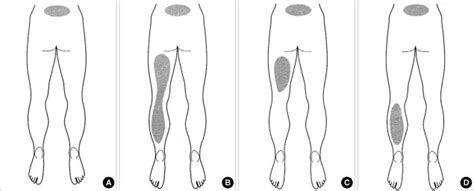 Types of pain distribution patterns in lumbar zygapophyseal joint... | Download Scientific Diagram