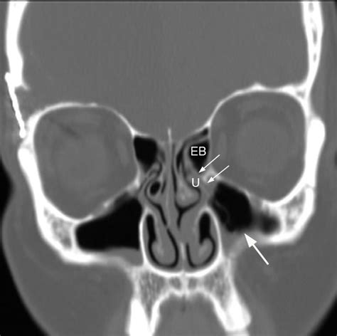 Radiologist For Ever: Paranasal sinuses rule 3 :Causes of sinus ...