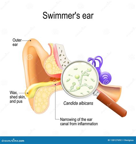 Fungal Infection On Scalp Vector Illustration | CartoonDealer.com #155633770