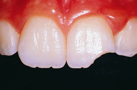 Dental Trauma – Core EM