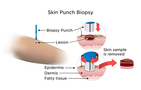 Skin Biopsy