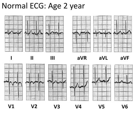 Paediatric ECG Interpretation • LITFL • ECG Library Basics