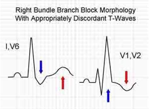 ECG Solution: The Right Stuff