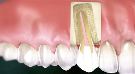 rct dental – root canal – Dadane