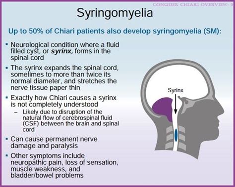 A syrinx is a common diagnosis with #Chiari #Malformation and can affect its symptoms and choice ...