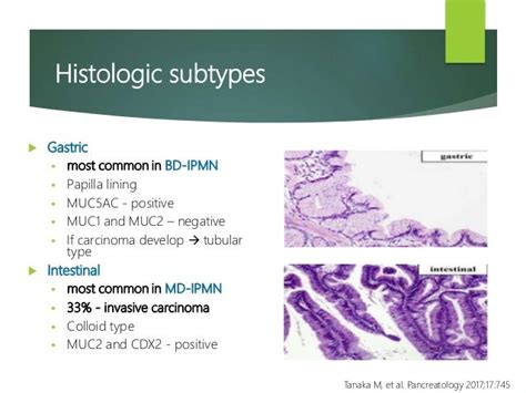 Management of IPMN