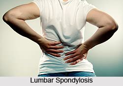 Treatment of Lumbar Spondylosis