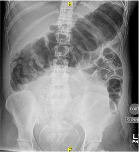 Figure 1 from Toxic megacolon during pregnancy in ulcerative colitis: A ...