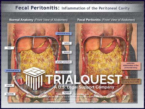 Fecal Peritonitis: Inflammation of the Peritoneal Cavity - TrialExhibits Inc.