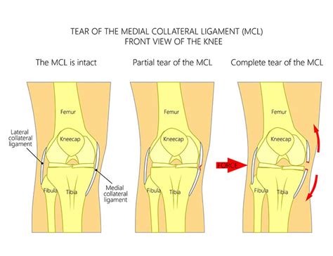 Sports Injury Treatment in Kerala | Ligament Tear Treatment India