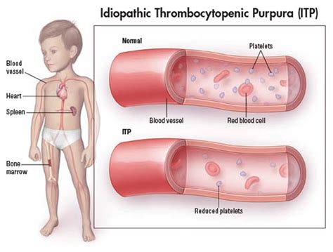 Prepare for Medical Exams : A Case Of Idiopathic Thrombocytopenic Purpura