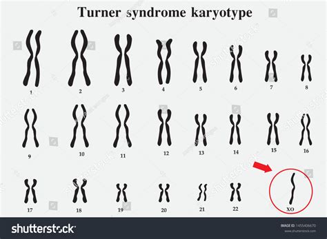 Karyotype Turner Syndrome Ts Known 45x Stock Vector (Royalty Free ...