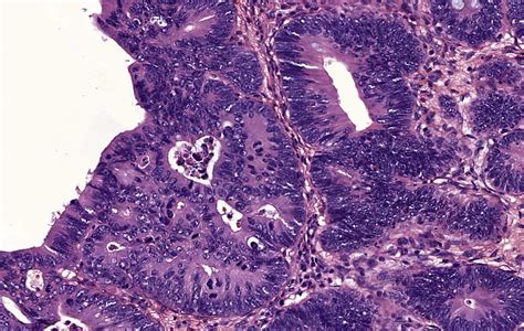 Pathology Outlines - Tubulovillous / villous adenoma