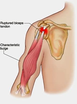 The Amazing Bodybuilding: Biceps Tendon Rupture and Advances in Surgical Treatment